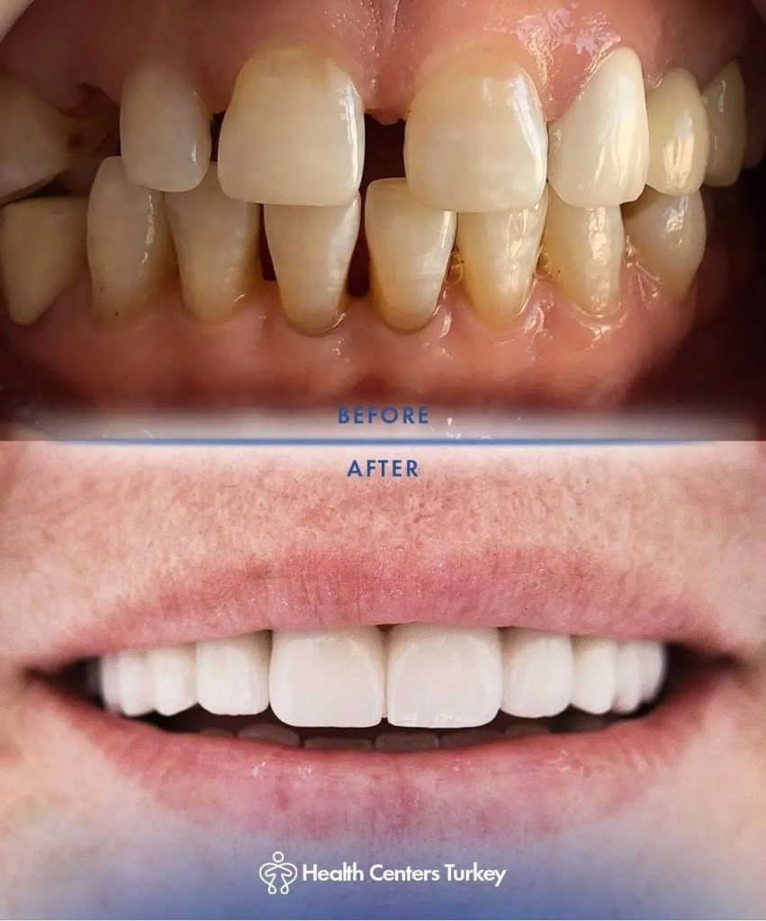 How much do veneers cost in Turkey before after 4