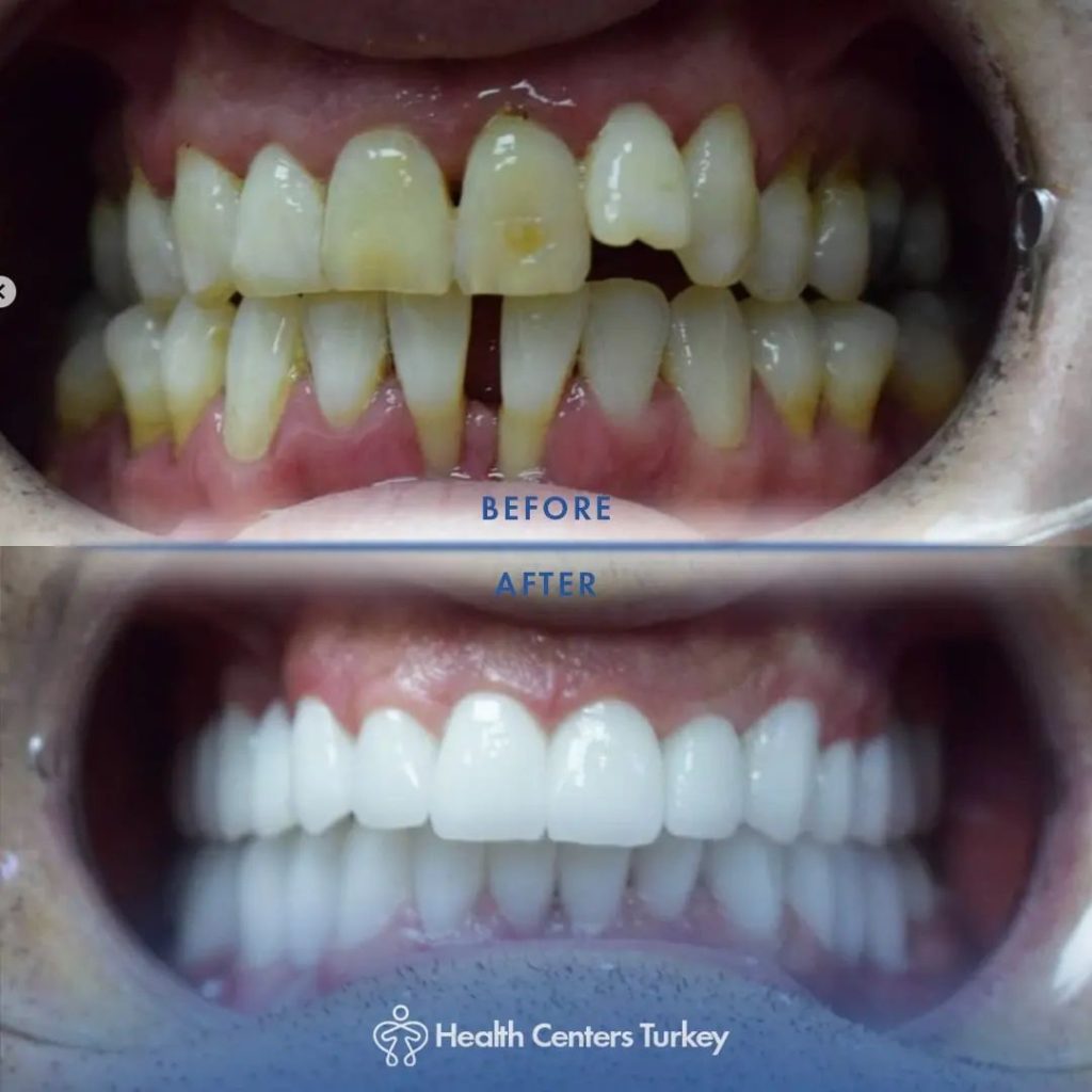 How much do veneers cost in Turkey Before-After 11
