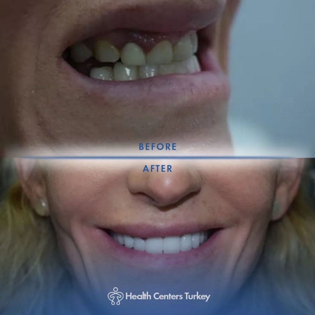 How much do veneers cost in Turkey Before-After 8