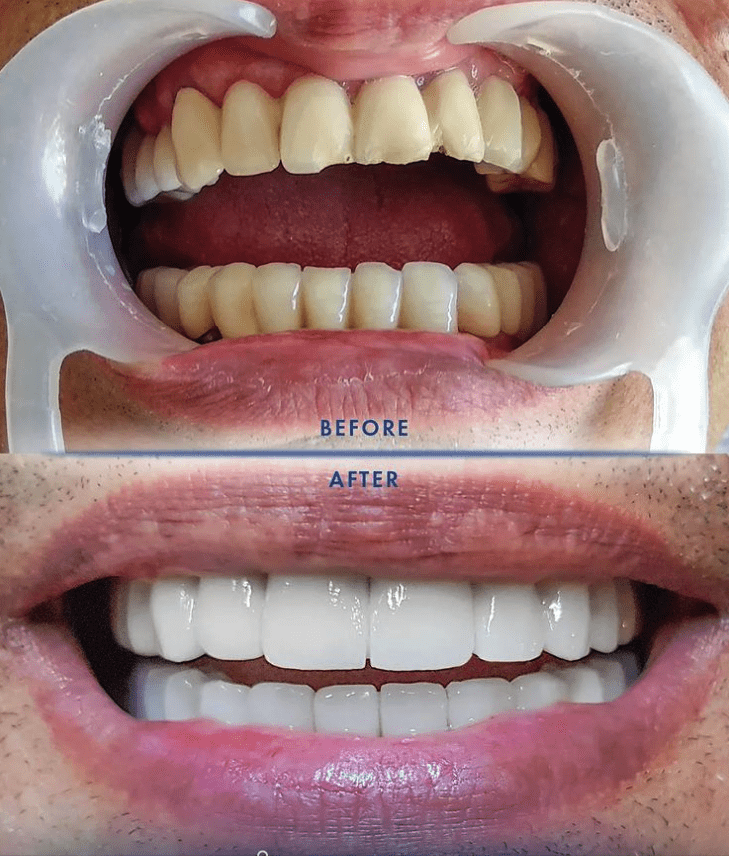 How much do veneers cost in Turkey before after 3