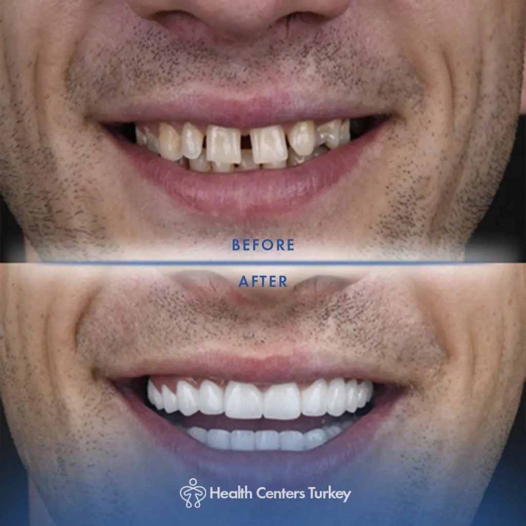 How much do veneers cost in Turkey Before-After 9