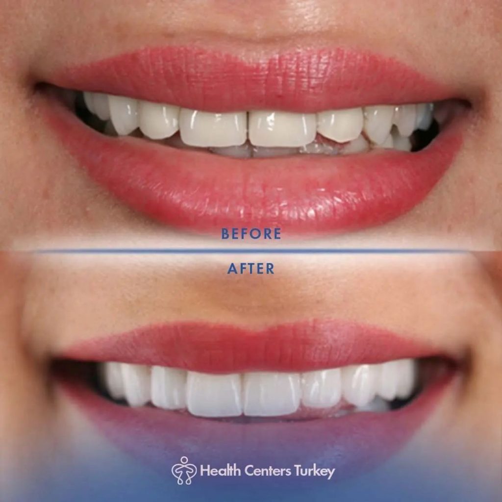 How much do veneers cost in Turkey Before-After 10