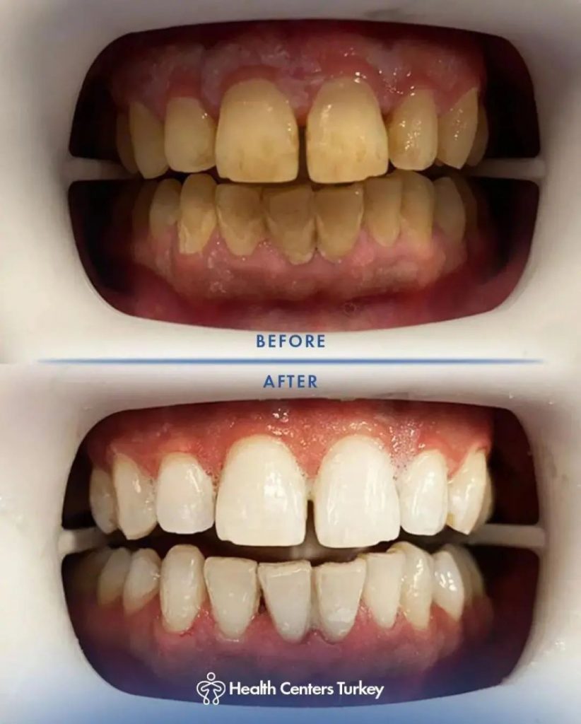 Professional teeth whitening before and after results at HCT Dental Clinic, Antalya, Turkey, showcasing a brighter smile transformation.