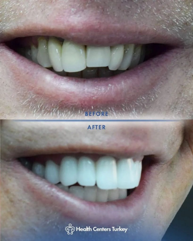 Before and after comparison of a successful cosmetic dental transformation at HCT Dental Clinic, a leading Dental Centre Turkey in Antalya, showcasing improved dental aesthetics.