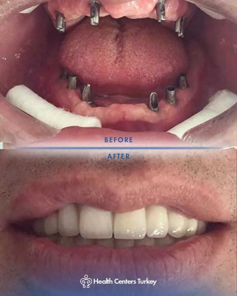 Before and After full mouth dental implant results at HCT Dental Clinic in Antalya, Turkey