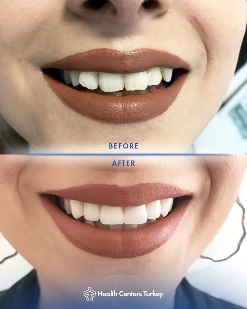 Before and after image showcasing comprehensive dental transformation results from cosmetic or restorative procedures at HCT Dental Clinic, a leading dental centre in Antalya, Turkey, highlighting enhanced smile aesthetics and functional improvements.
