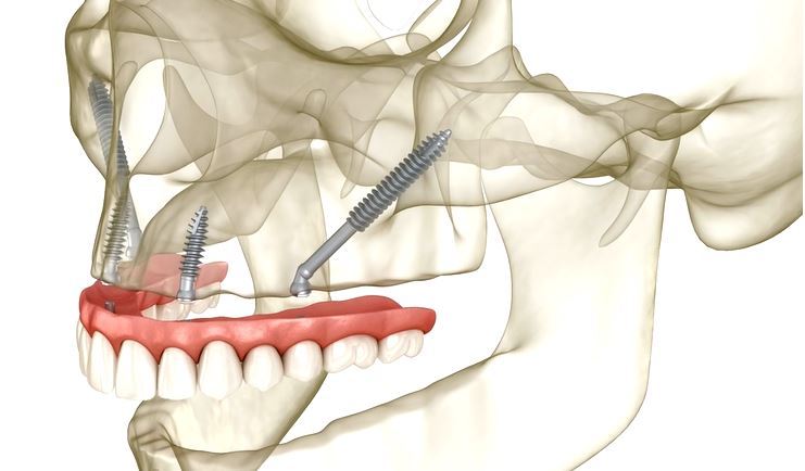 zygomatic implants