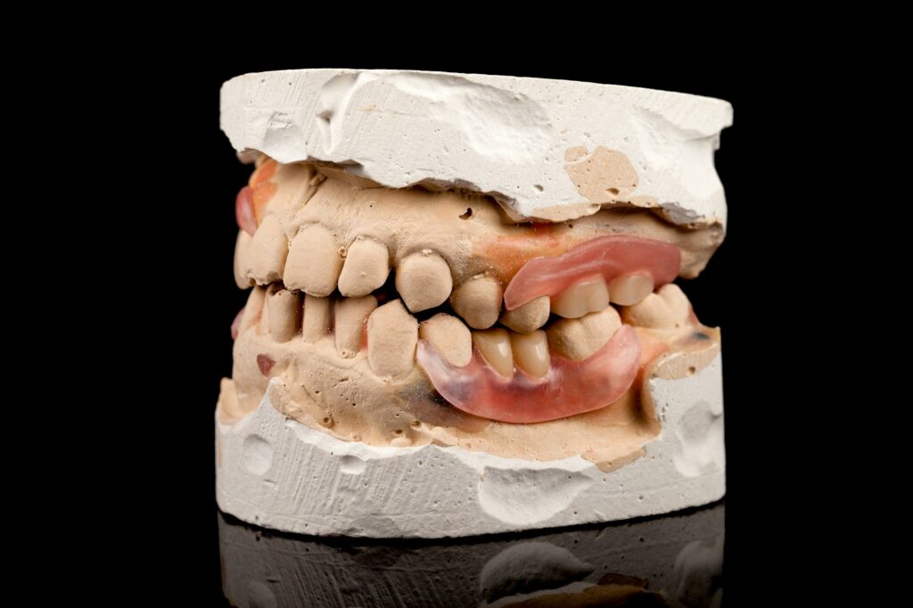 Dentures on a plaster cast