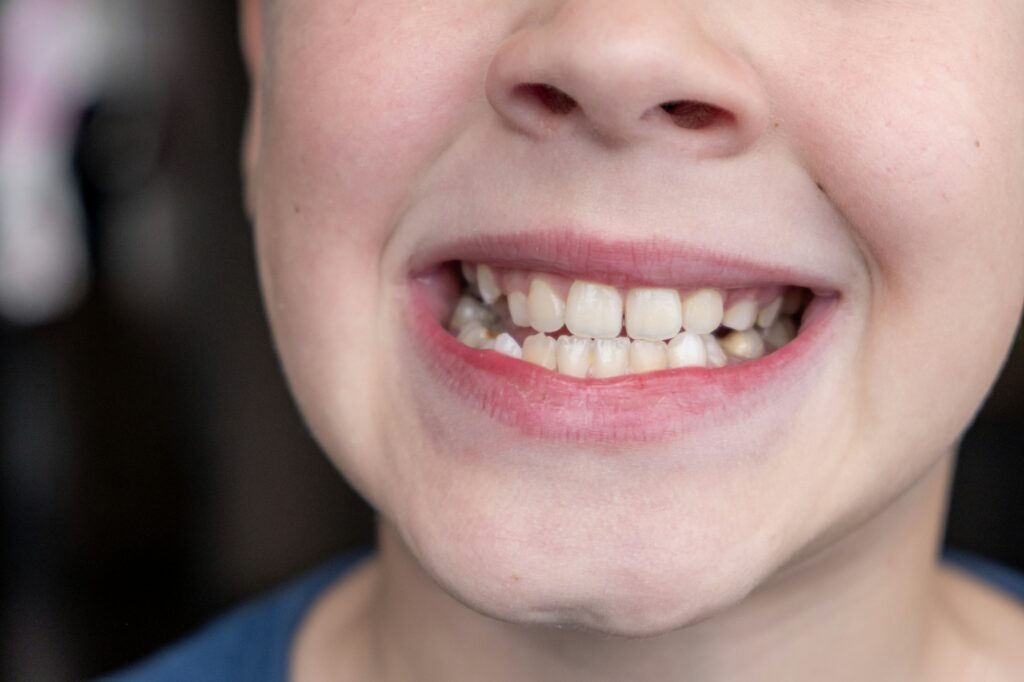 Child's crooked teeth. Young man showing crooked growing teeth.