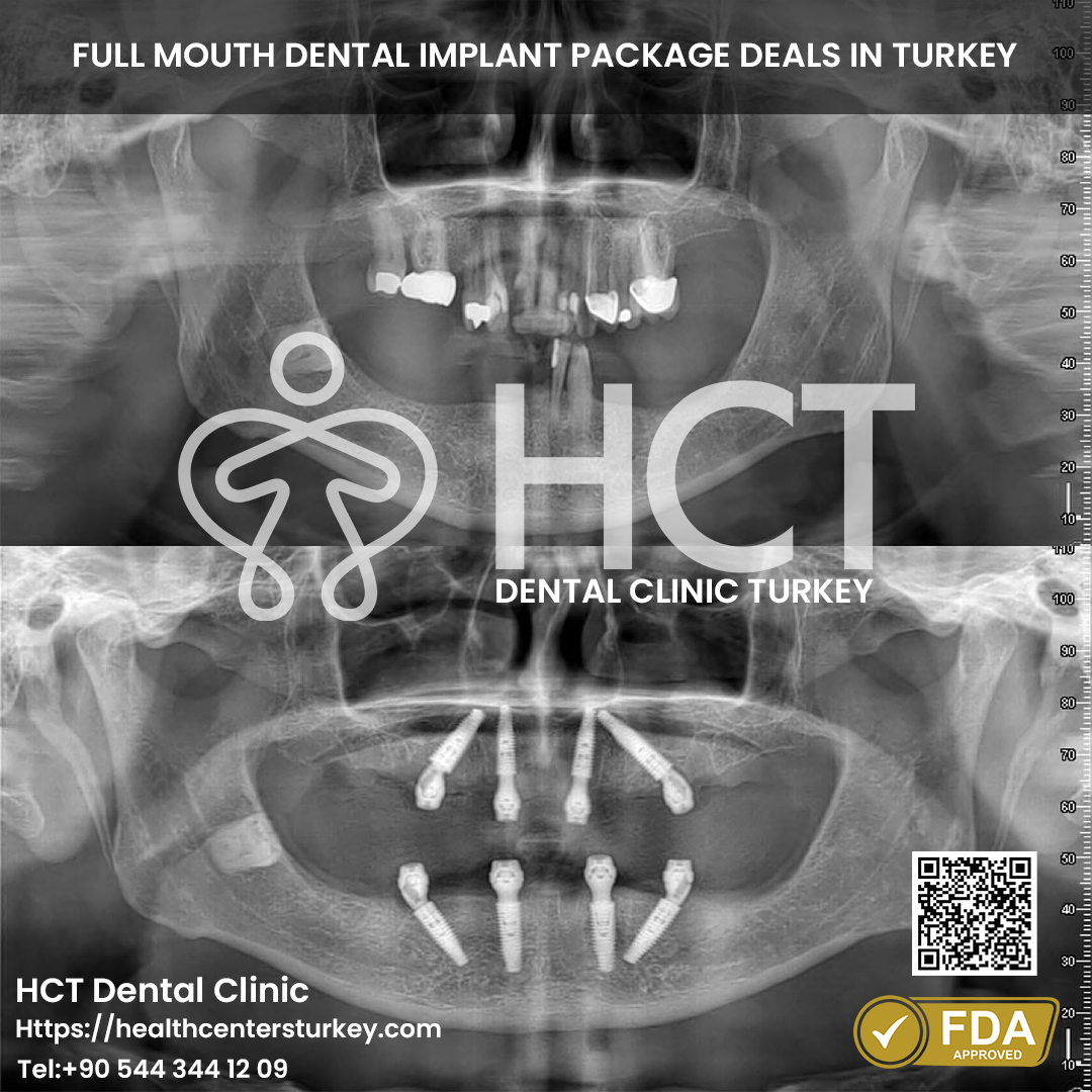 Affordable All-on-4 dental implants Turkey package price and deals
