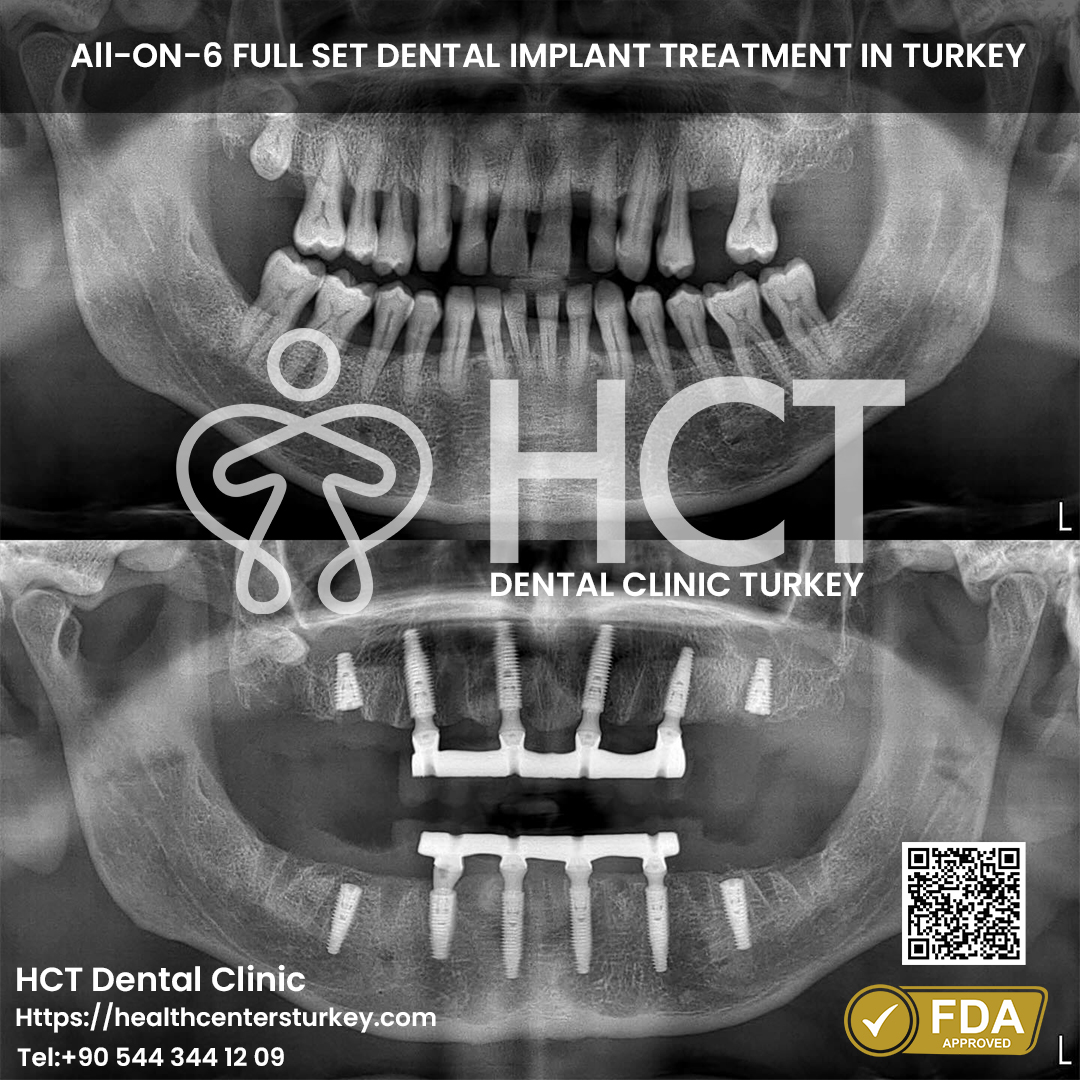 cheap all on 6 full set dental implants turkey package deals before after x-ray picture