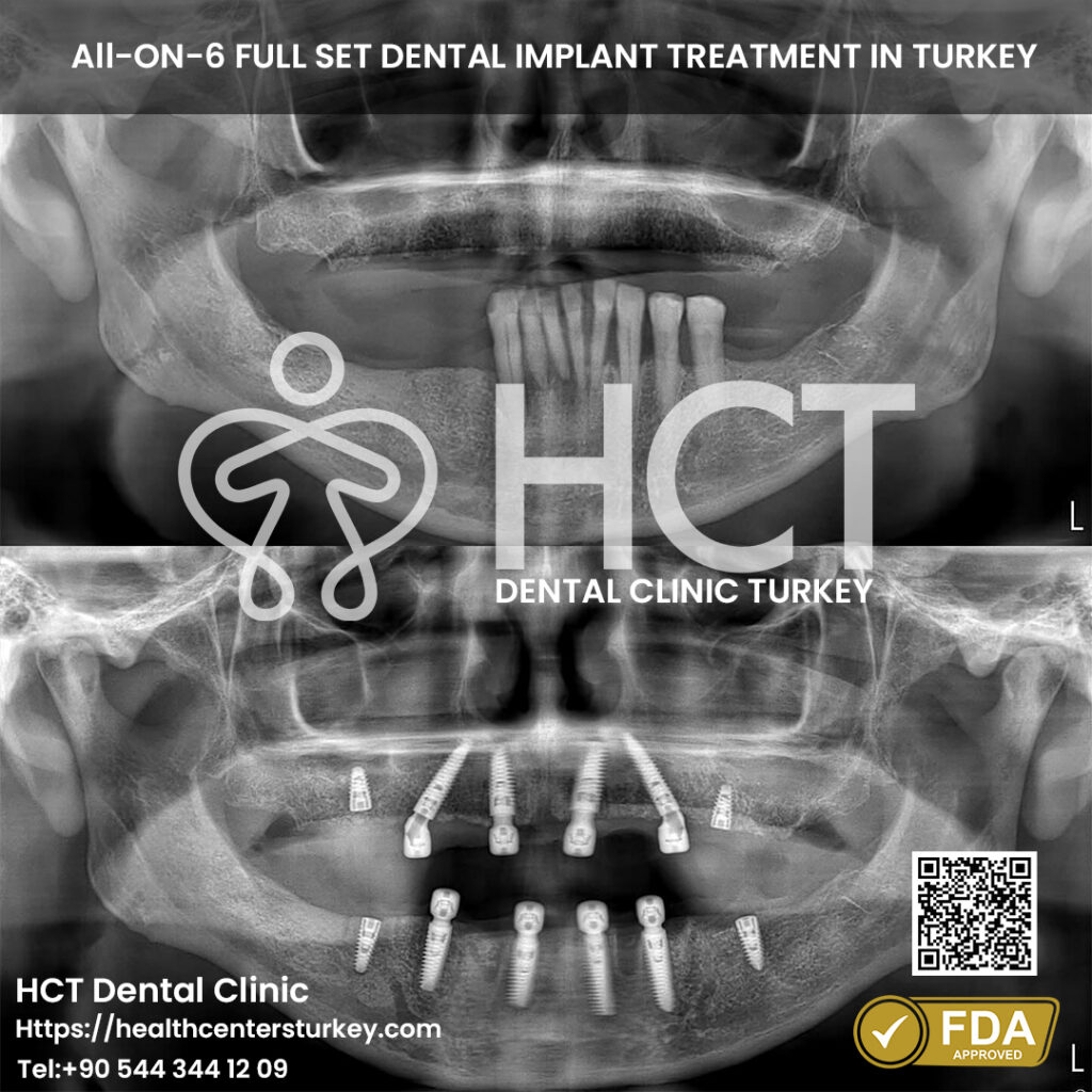 affordable full mouth dental implants turkey package deals before after x-ray in Turkey HCT Dental Clinic