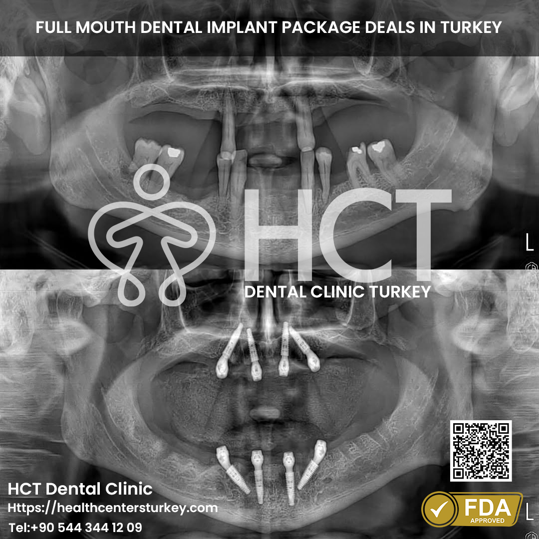 Best All-on-4 dental implants cost in Turkey, available in Antalya and Istanbul