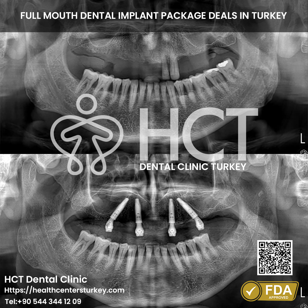 All-on-4 dental implants surgery process in Turkey for full arch restoration
