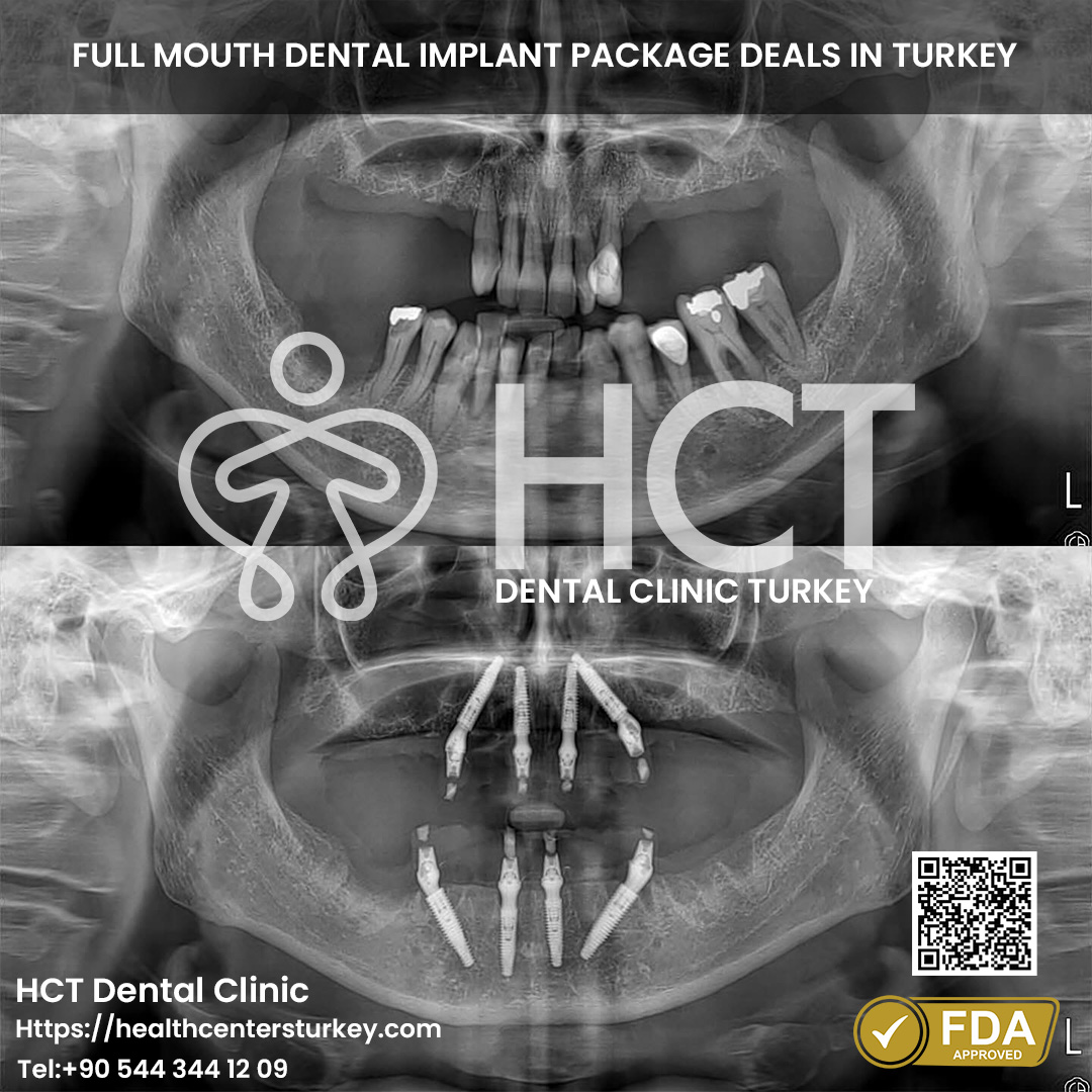 All-on-4 dental implants Turkey affordable package deals for full mouth reconstruction