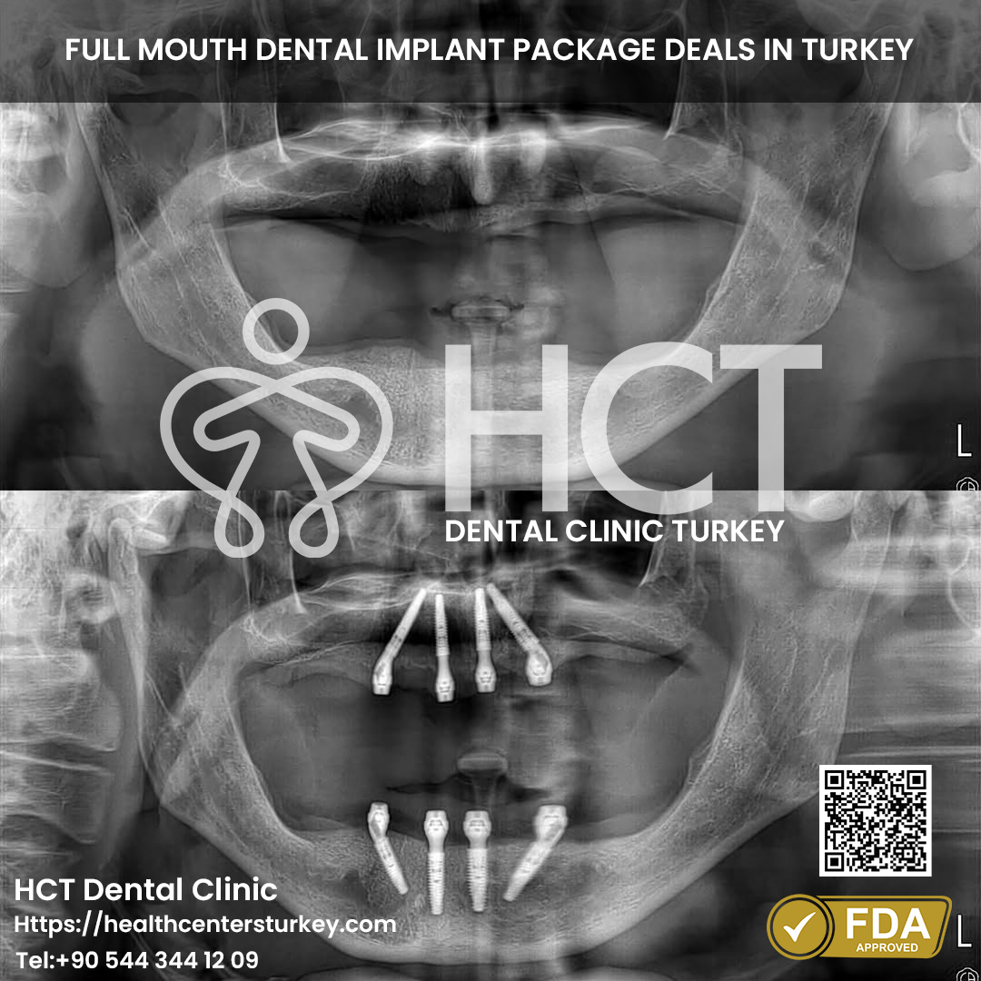 All-on-4 dental implants Turkey before and after results with patient reviews