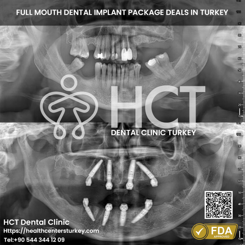 Best clinic reviews for All-on-4 dental implants Turkey