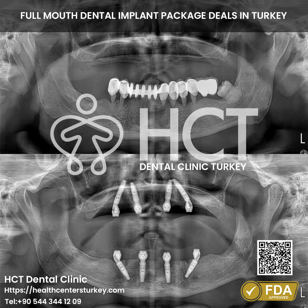 All-on-4 dental implants Turkey price and patient reviews for full mouth restoration