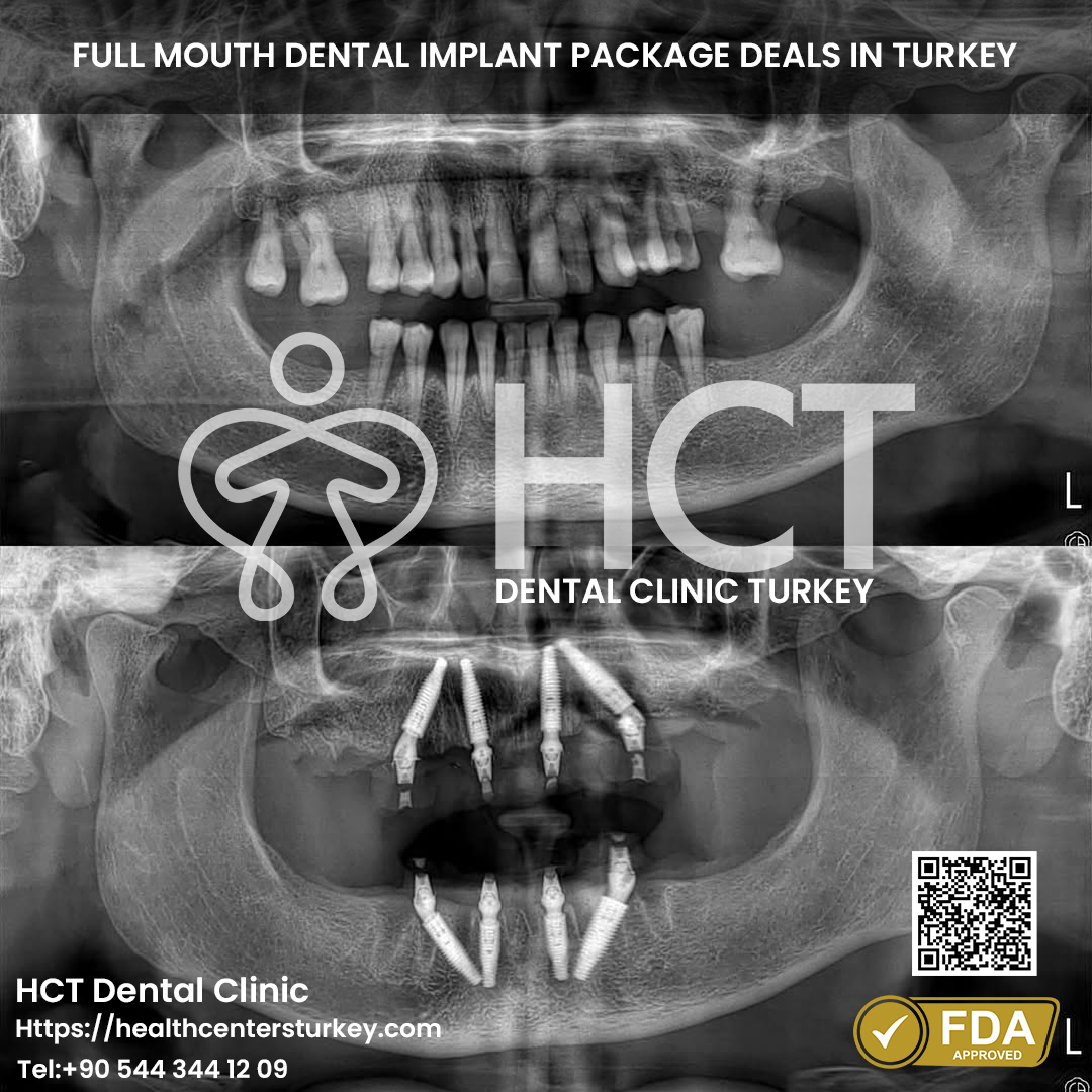 Full mouth All-on-4 dental implants Turkey reviews and results