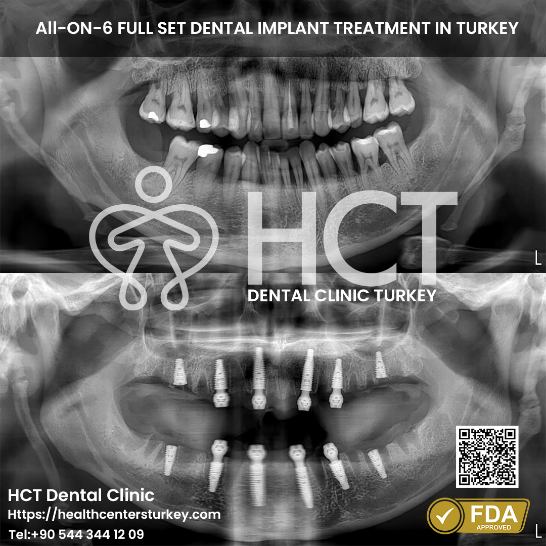 all on 6 dental implants package deals turkey before after picture from best dental clinic in Turkey HCT Dental Clinic