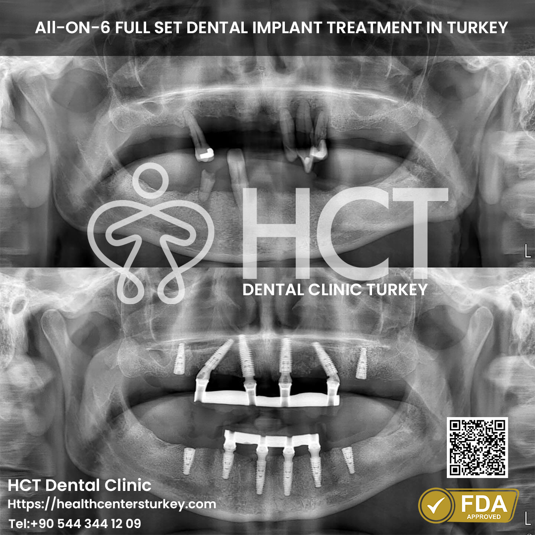 full mouth dental implant turkey package deals full set all on 6 both jaw before after x-ray picture