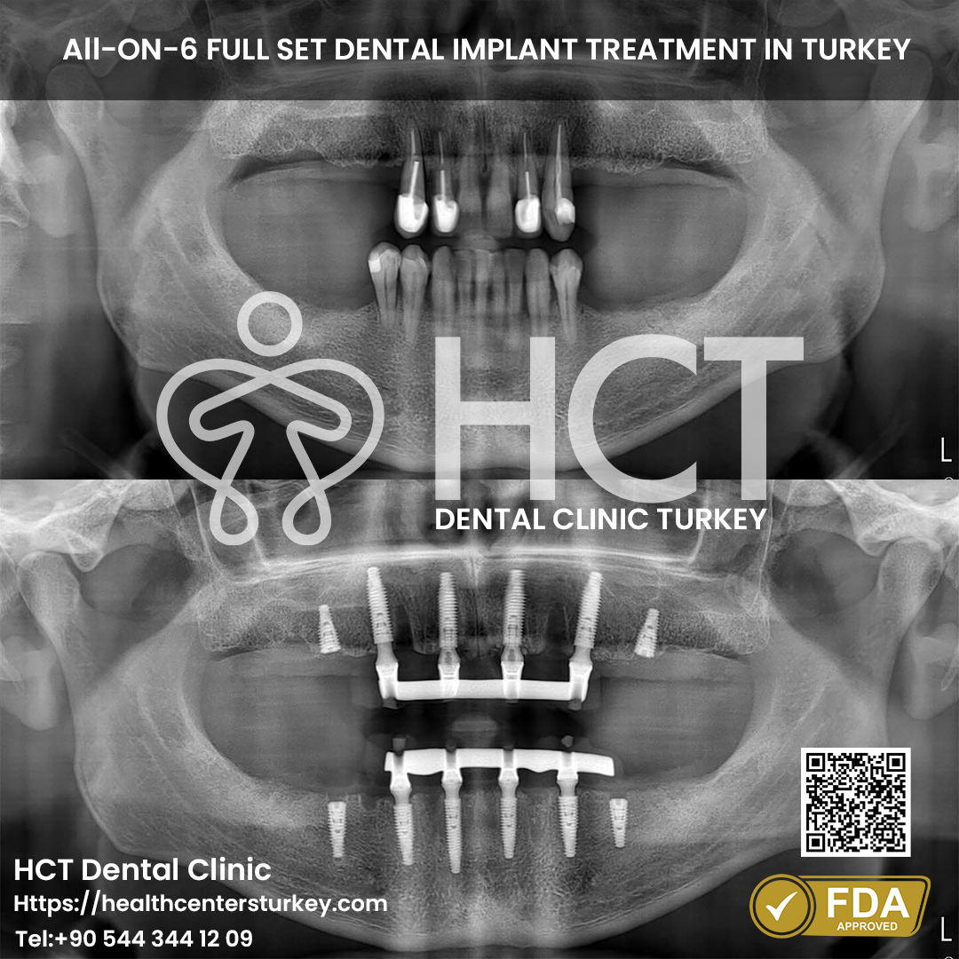 full set all on 6 dental implant turkey package deals x-ray before after picture from HCT Dental Clinic