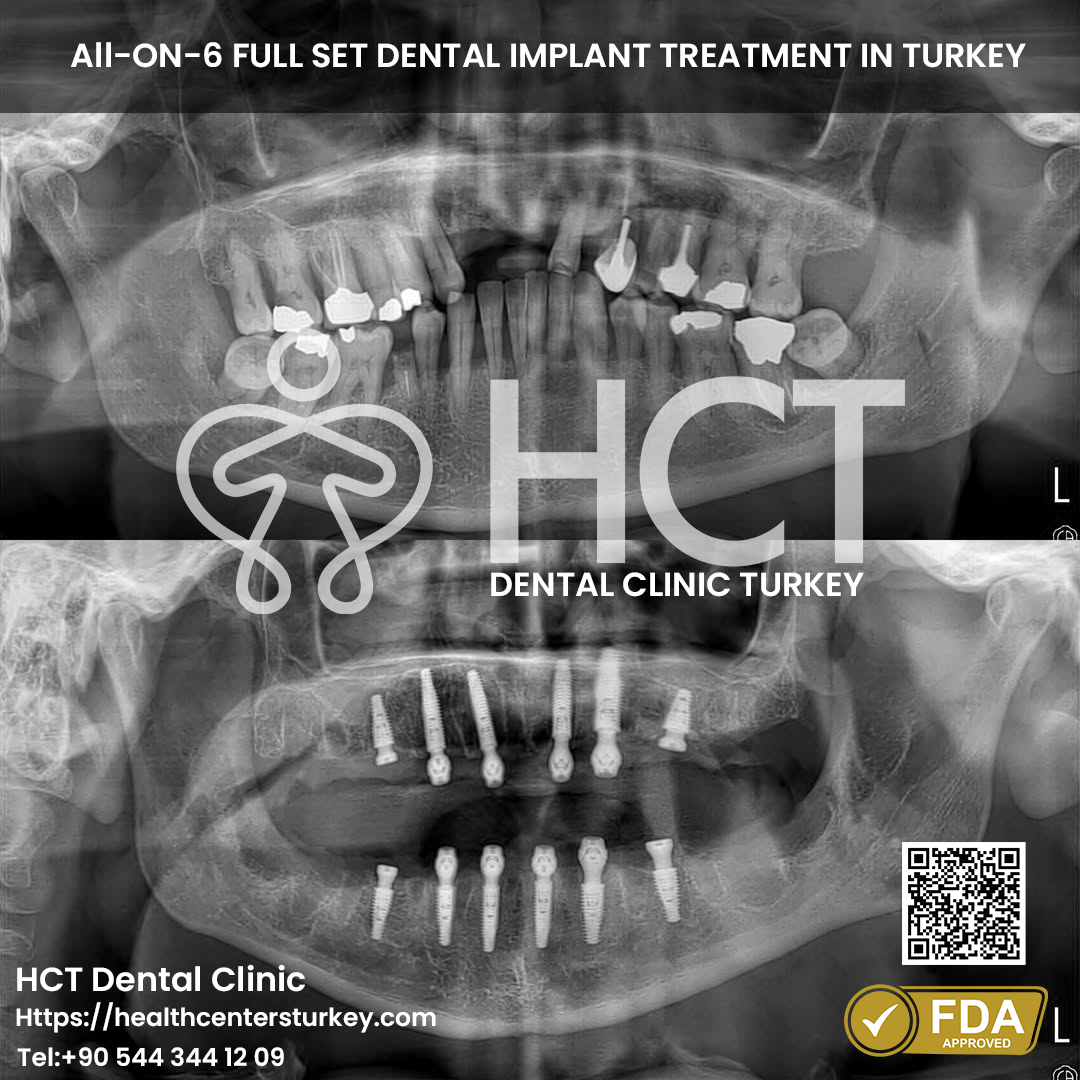 full mouth dental implant turkey package deals x-ray before after