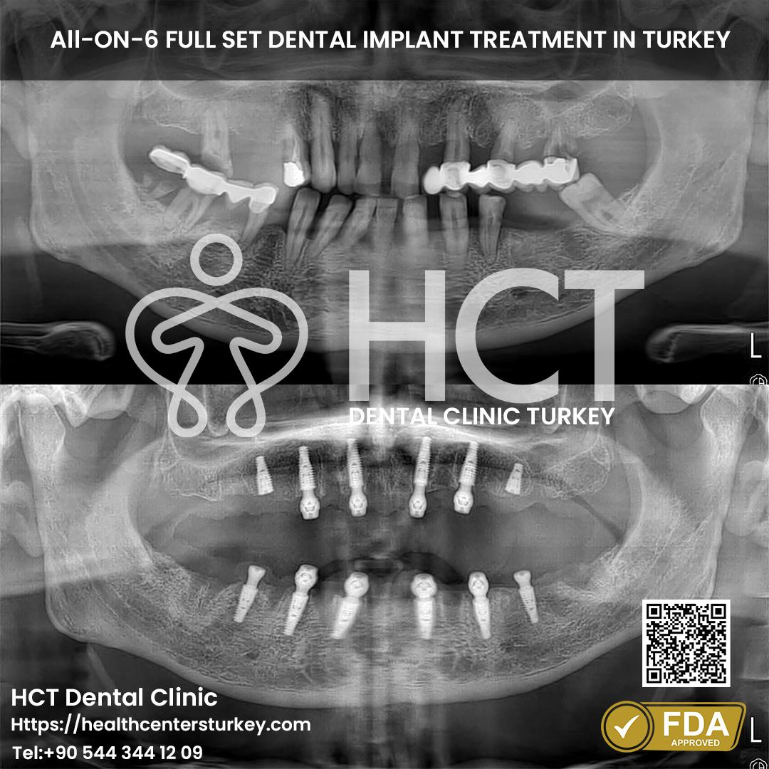 Panoramic X-Ray Before and After All-on-6 Dental Implants in Turkey