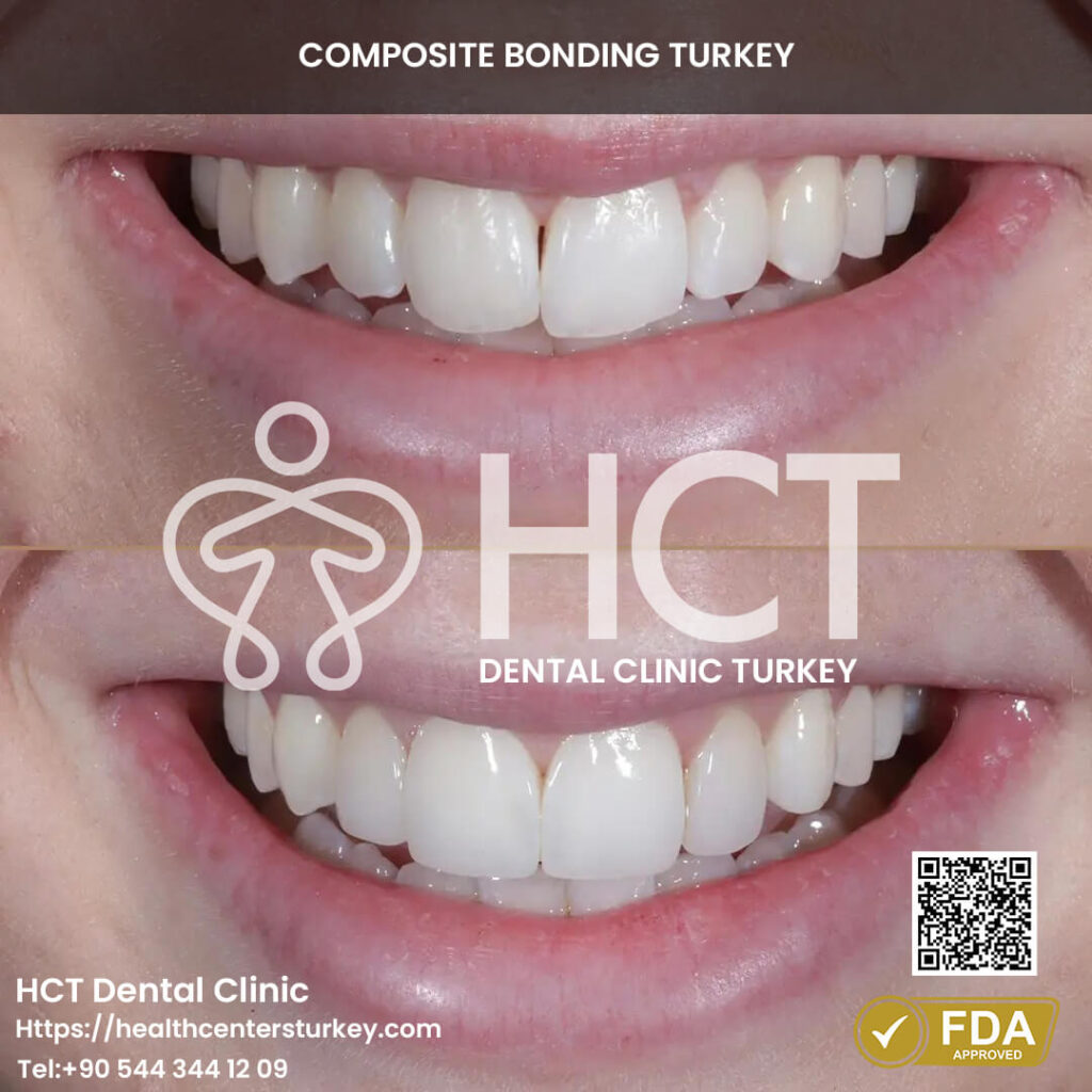 Composite Bonding Turkey Cost - Benefits - Package Deals 20 Teeth treated with composite bonding veneers for a natural appearance.