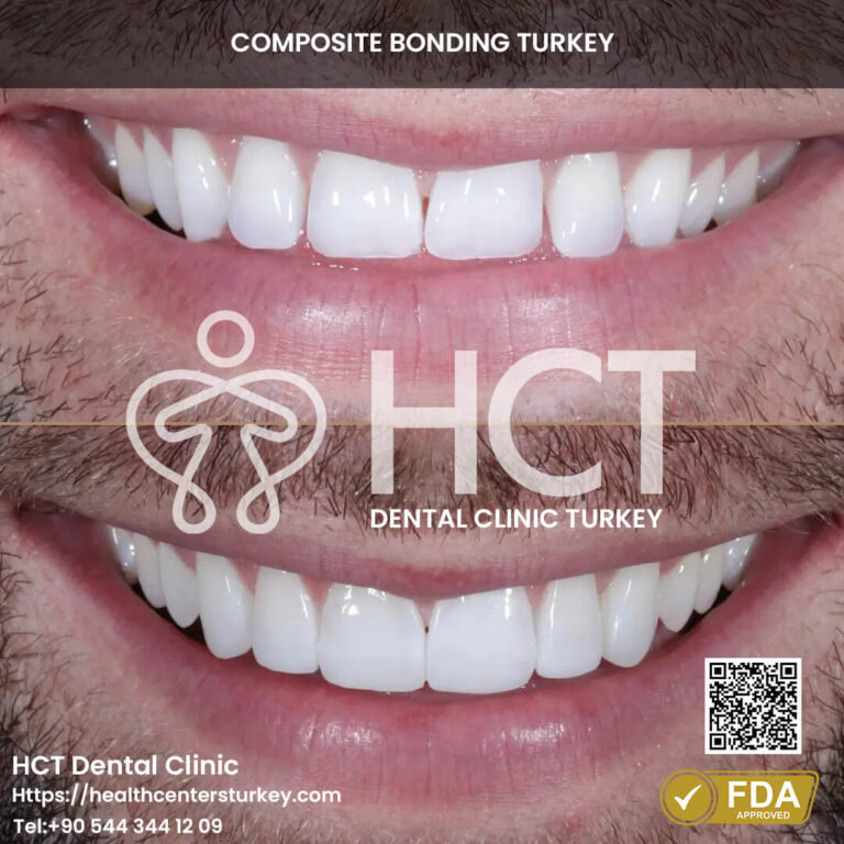 Is Composite Bonding in Turkey Safe? 2026 Expert Guide 21 A front-teeth restoration with composite bonding results.