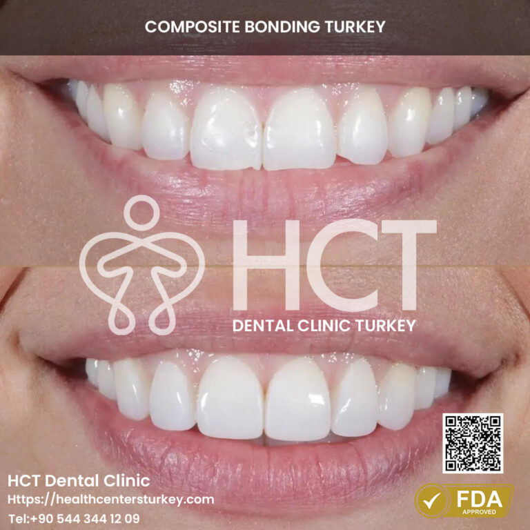 Achieve symmetrical teeth with composite bonding treatments.