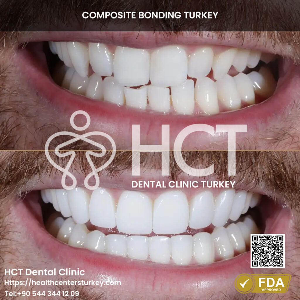 Composite Bonding Turkey Cost - Benefits - Package Deals 5 A confident smile restored with composite bonding.