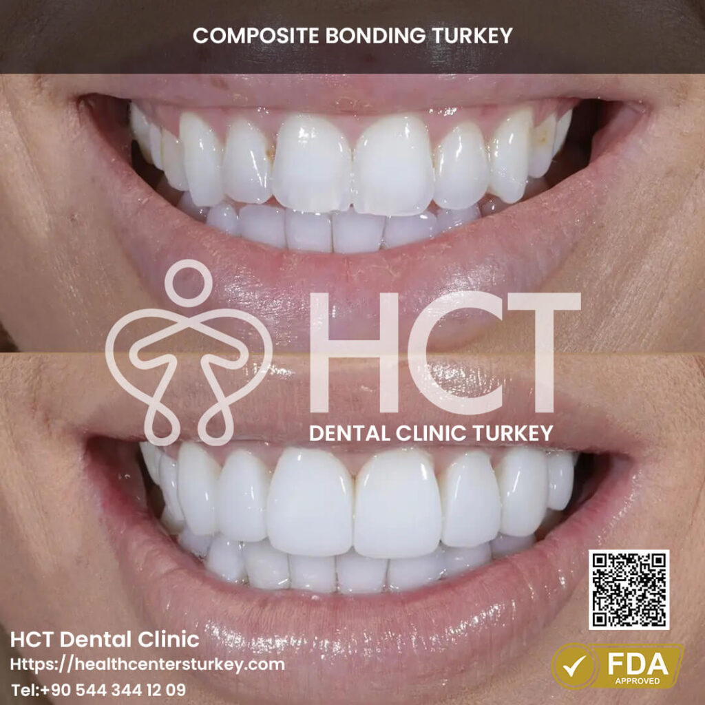 Composite Bonding Turkey Cost - Benefits - Package Deals 11 Aesthetic smile transformation with composite bonding in Turkey.