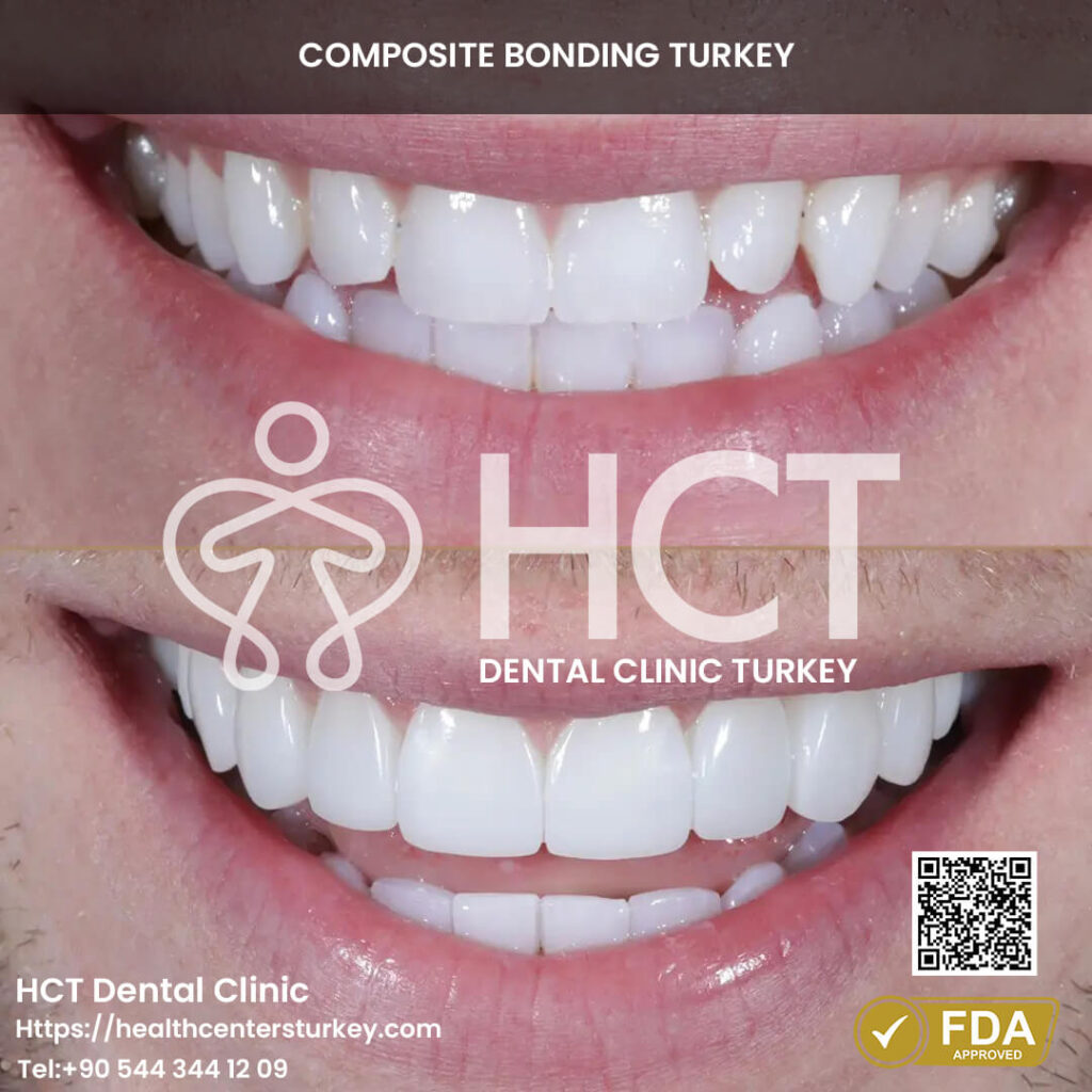 Composite Bonding Turkey Cost - Benefits - Package Deals 12 Cracked teeth before and after composite bonding repair.