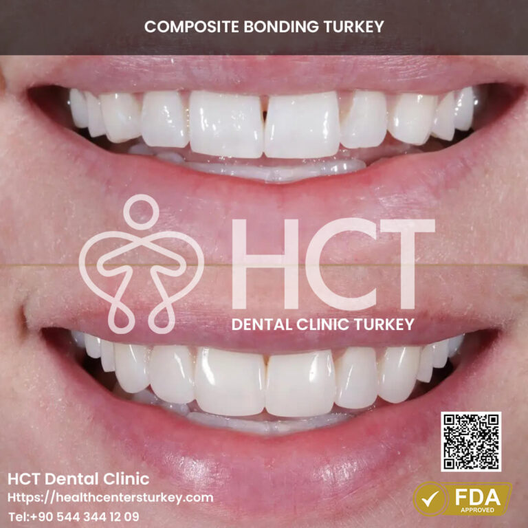 Composite bonding results for removing stains and discoloration.