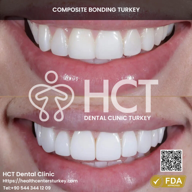 Before and after composite bonding for closing gaps between teeth.