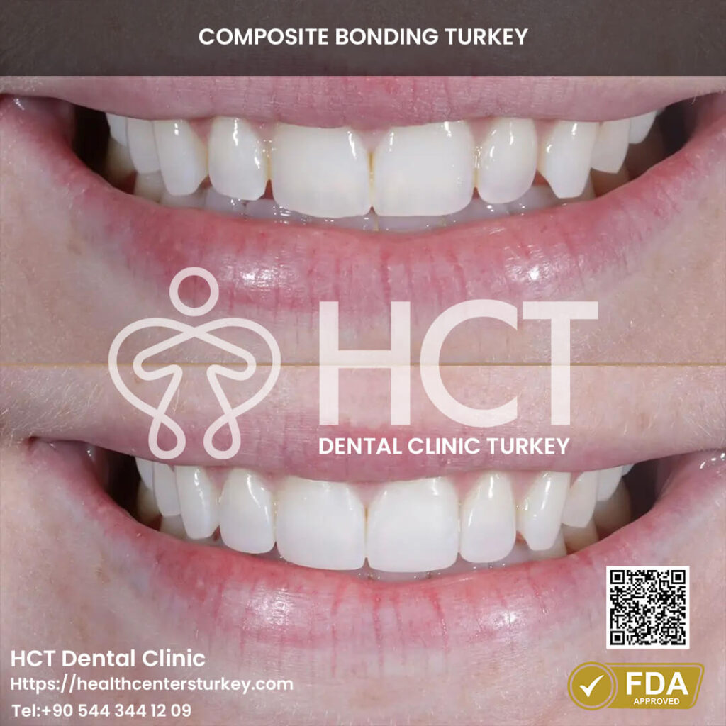Composite Bonding Turkey Cost - Benefits - Package Deals 8 Composite bonding results showcasing a bright and vibrant smile.