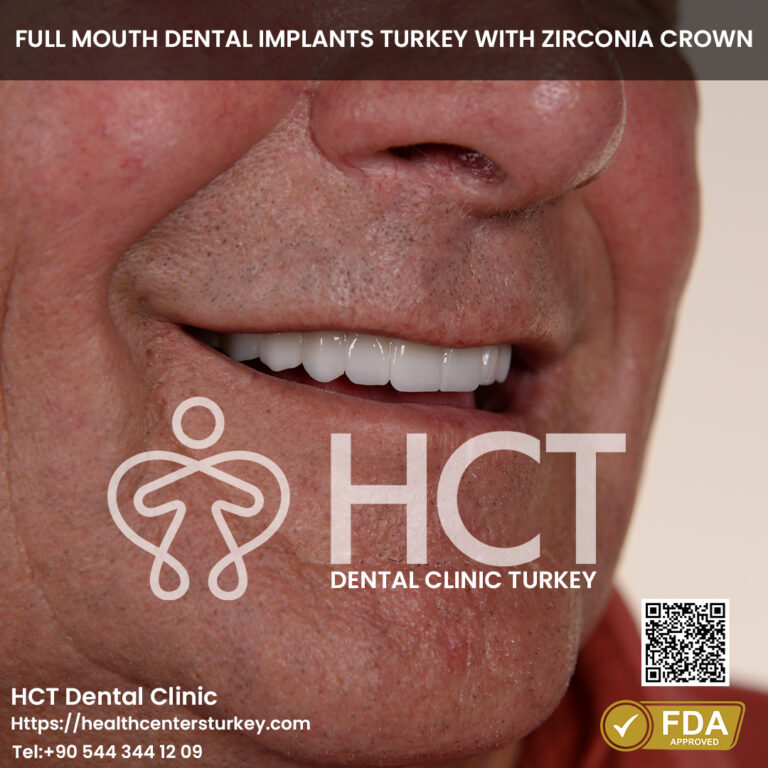 full set dental implants turkey package deals turkey final result.