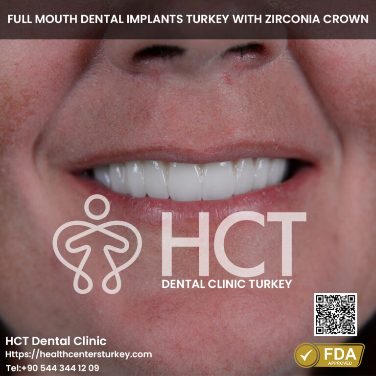 Smile Reconstruction with full mouth dental implants turkey package deals final result in antalya