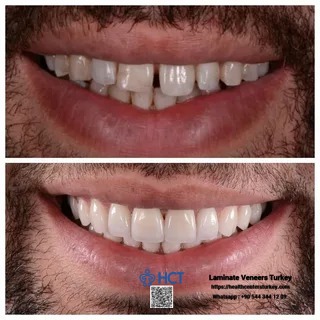 Laminate Veneers Turkey uses advanced technology to design perfect Laminate Teeth.