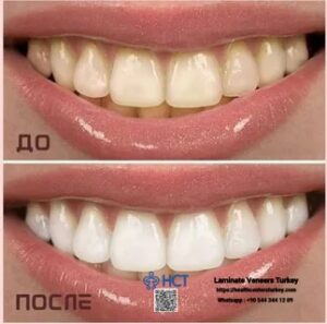 Laminate Veneers Turkey 21 Laminate Veneers Turkey restores confidence with custom-made Laminate Teeth solutions.