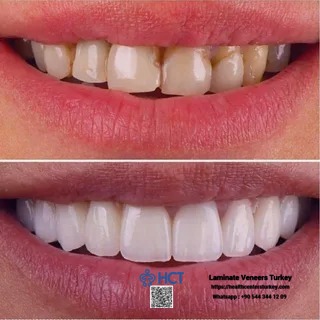 Laminate Veneers Turkey enhances oral health and aesthetics with durable Laminate Teeth.