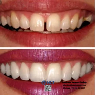 Laminate Veneers Turkey corrects dental imperfections with expertly made Laminate Teeth.