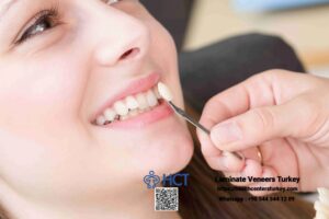 Laminate Veneers Turkey offers long-lasting beauty with stain-resistant Laminate Teeth.