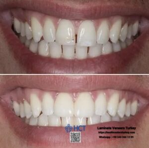 Laminate Veneers Turkey 11 Laminate Veneers Turkey transforms discolored or chipped teeth into radiant Laminate Teeth.