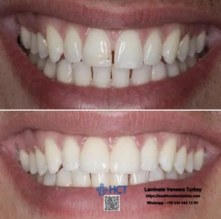 Laminate Veneers Turkey transforms discolored or chipped teeth into radiant Laminate Teeth.