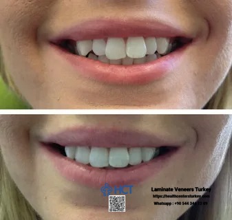 Laminate Veneers Turkey ensures a perfect fit and natural look for Laminate Teeth.