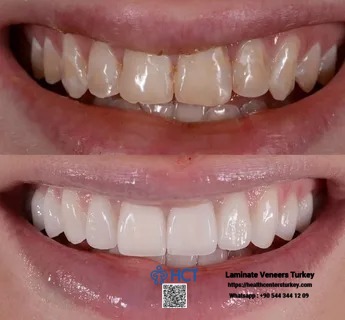 Laminate Veneers Turkey is a top choice for affordable dental tourism with Laminate Teeth.