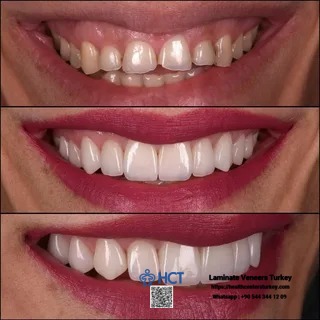 laminate_veneers_turkey_teeth_before_after