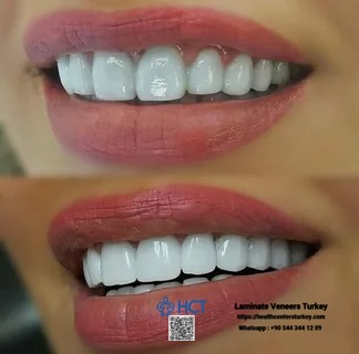 Laminate Veneers Turkey uses cutting-edge techniques to bond Laminate Teeth seamlessly.